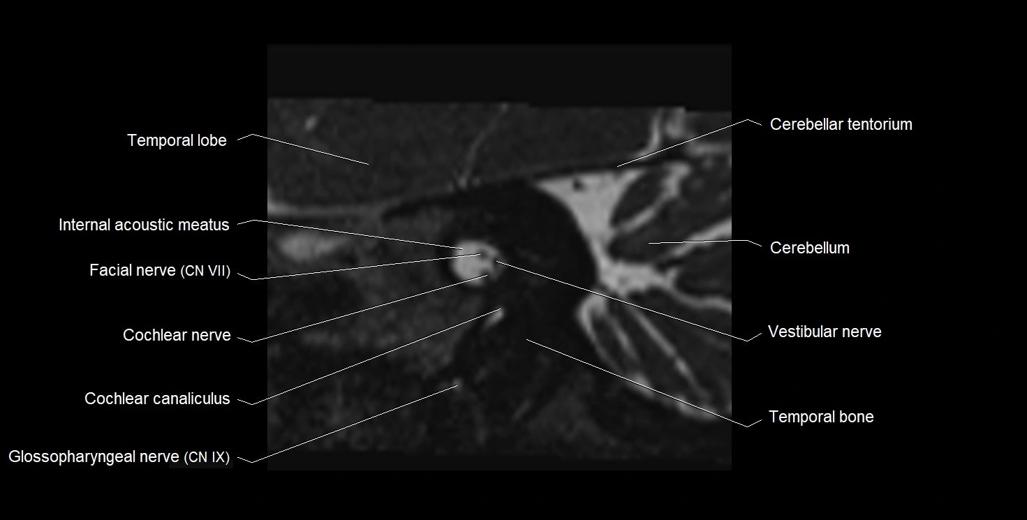 Internal auditory meatus (IAM) 3T sagittal cross sectional anatomy image 19.webp